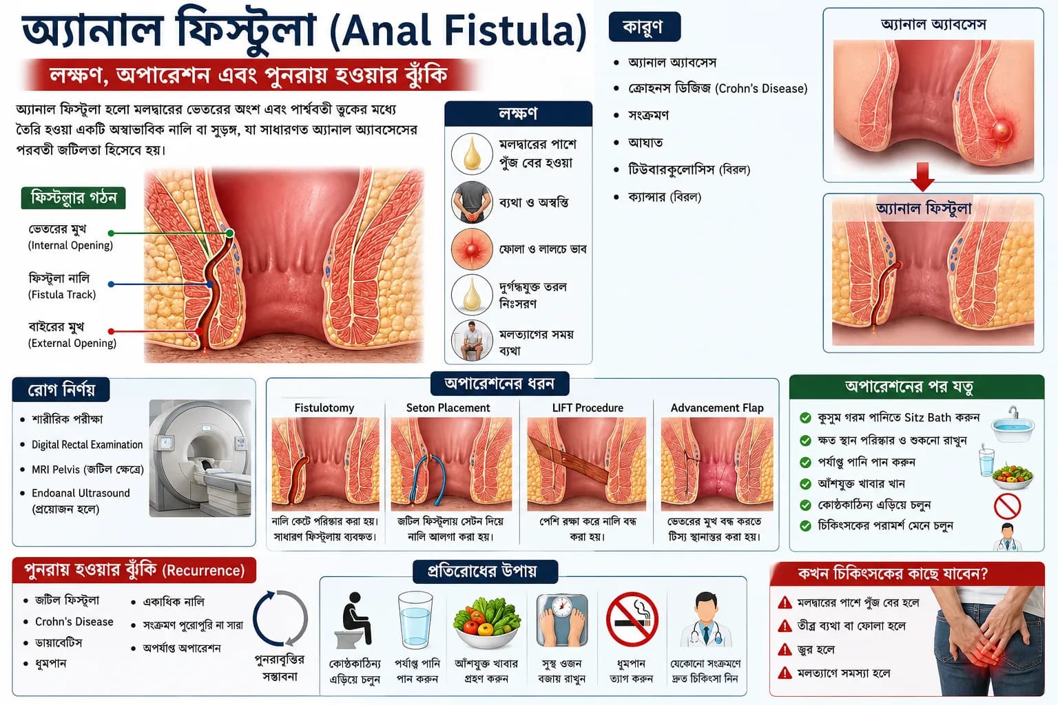 অ্যানাল ফিস্টুলা (Anal Fistula): লক্ষণ, অপারেশন, চিকিৎসা ও পুনরায় হওয়ার ঝুঁকি
