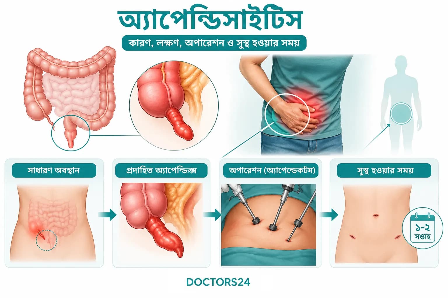 অ্যাপেন্ডিসাইটিস: কারণ, লক্ষণ, অপারেশন ও সুস্থ হওয়ার সময়