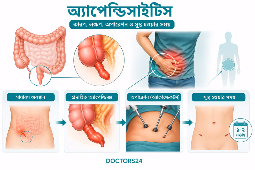 অ্যাপেন্ডিসাইটিস: কারণ, লক্ষণ, অপারেশন ও সুস্থ হওয়ার সময়