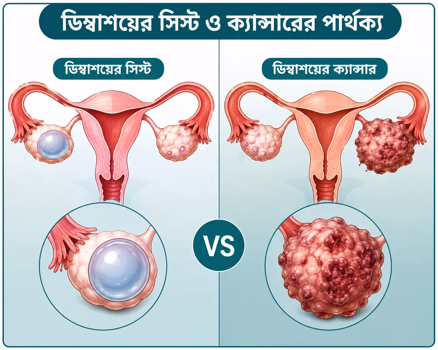 ডিম্বাশয়ের সিস্ট ও ক্যান্সারের পার্থক্য: কখন উদ্বিগ্ন হবেন?