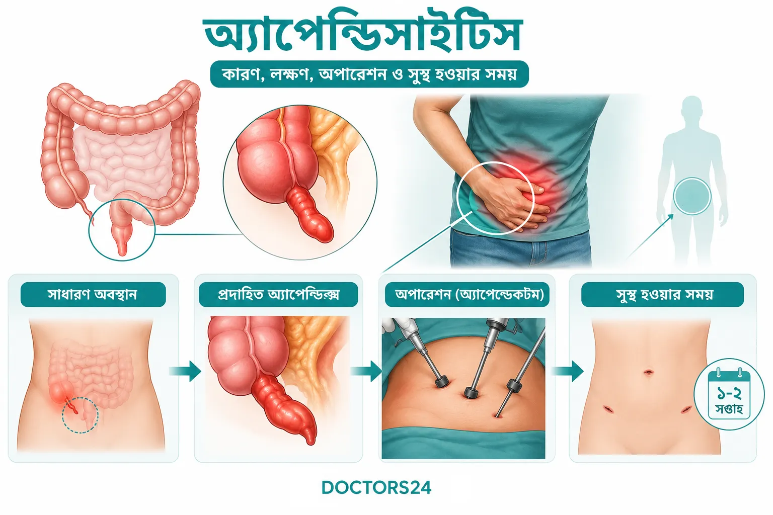 অ্যাপেন্ডিসাইটিস: কারণ, লক্ষণ, অপারেশন ও সুস্থ হওয়ার সময়