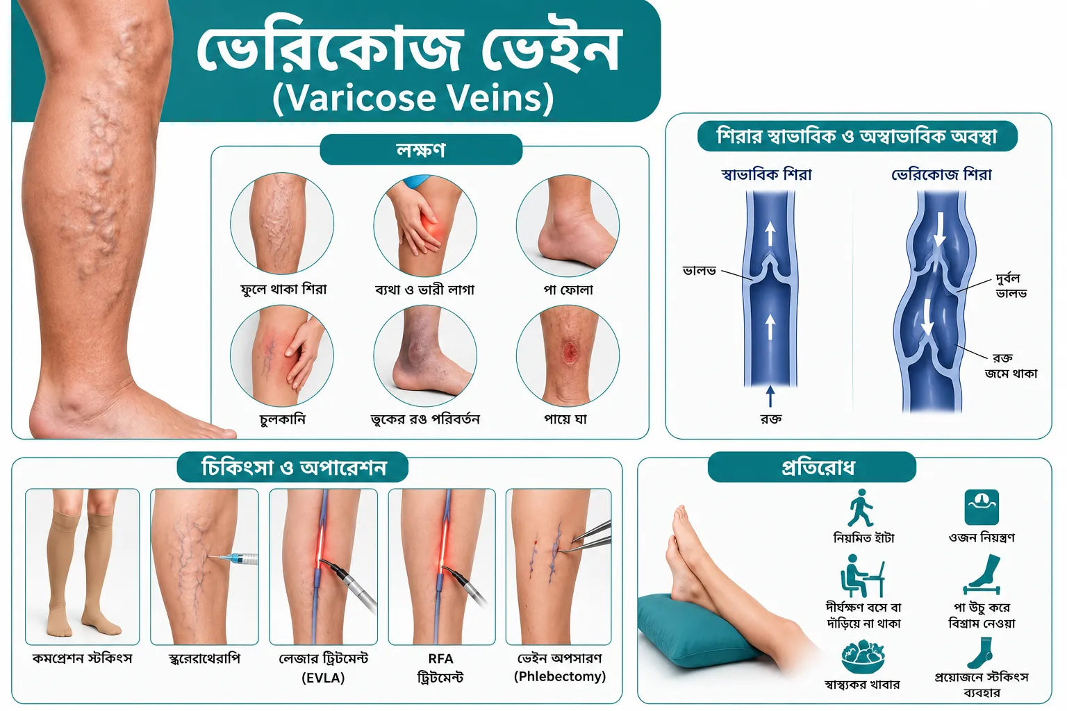 ভেরিকোজ ভেইন (Varicose Veins): লক্ষণ, চিকিৎসা ও অপারেশন