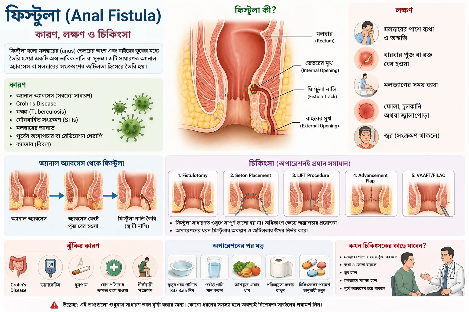 ফিস্টুলা (Anal Fistula): কারণ, লক্ষণ, চিকিৎসা ও কখন অপারেশন প্রয়োজন