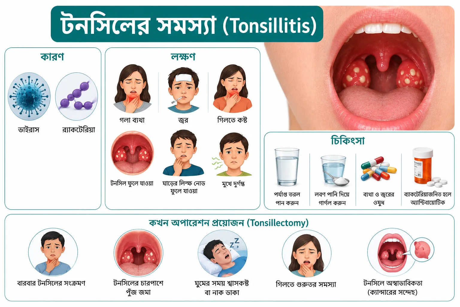 টনসিলের সমস্যা (Tonsillitis): কারণ, লক্ষণ, চিকিৎসা ও কখন অপারেশন প্রয়োজন